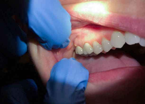 Best Emergency Dentist for Knocked-Out Tooth in Gulfport, FL